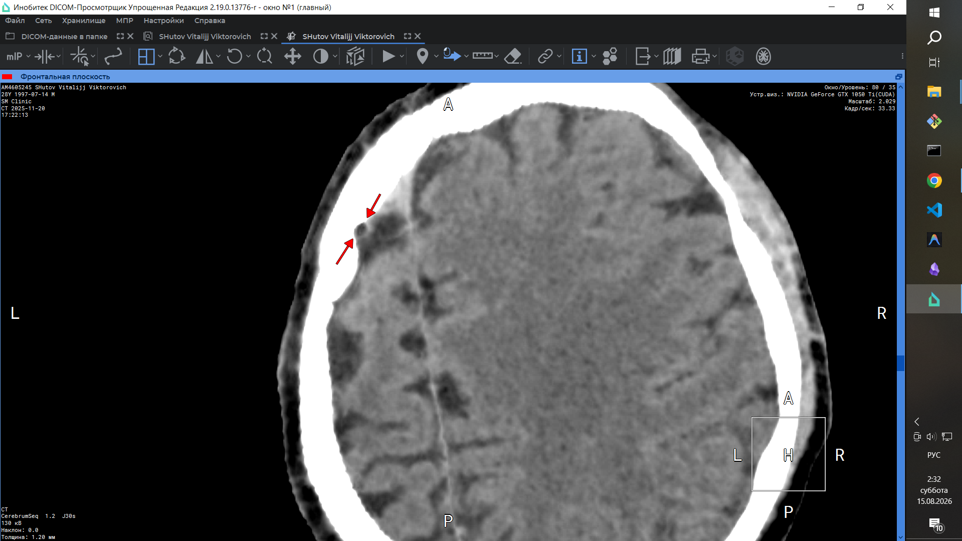 Illegal implant CT